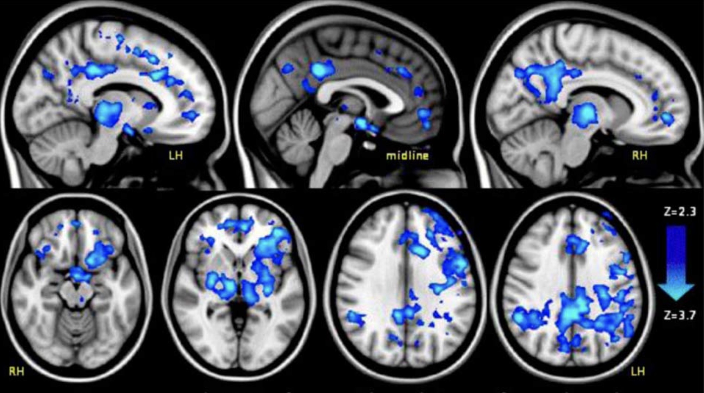 Grouping of brain scans for Ronnie Stangler MD good reads page regarding Psychedelics Light Up Brain Neuropathways.